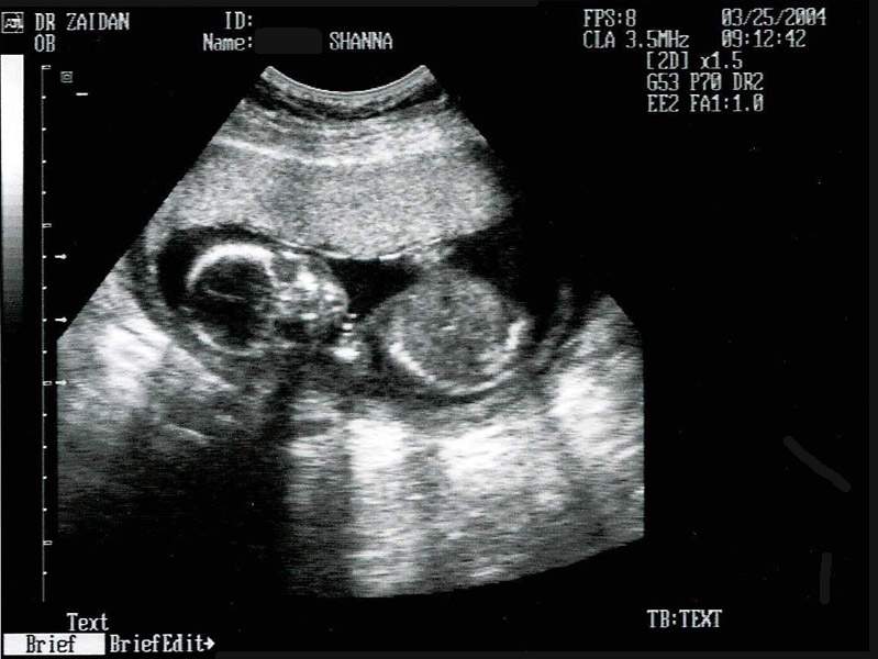 Ultrasound Photos Ultrasound Photos